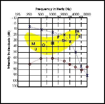audiogram